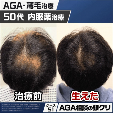 AGA・薄毛治療（50代 内服薬治療）50代の男性向けAGA（男性型脱毛症）と薄毛治療の内服薬による治療を提供するサービス