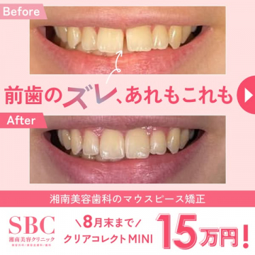 湘南美容のマウスピース矯正（前歯改善）