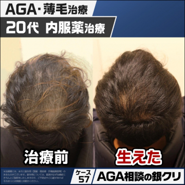 20代向けAGA・薄毛の内服薬治療専門クリニック