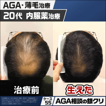 AGA・薄毛治療 20代向け内服薬治療
