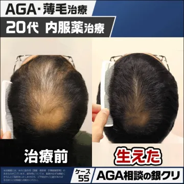 AGA・薄毛治療 20代向け内服薬治療