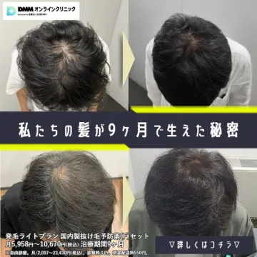 DMMオンラインクリニック AGA治療 9ヶ月で発毛体験