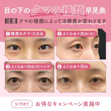 目の下のクマ治療キャンペーン（クマの種類別早見表付き）