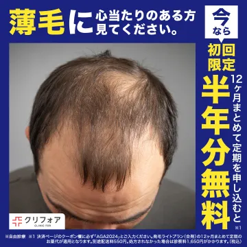 クリフォア AGA治療 半年分無料キャンペーン